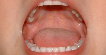 歯の詰め物が取れたらどうする?しばらくは歯医者にいかなくても大丈夫?